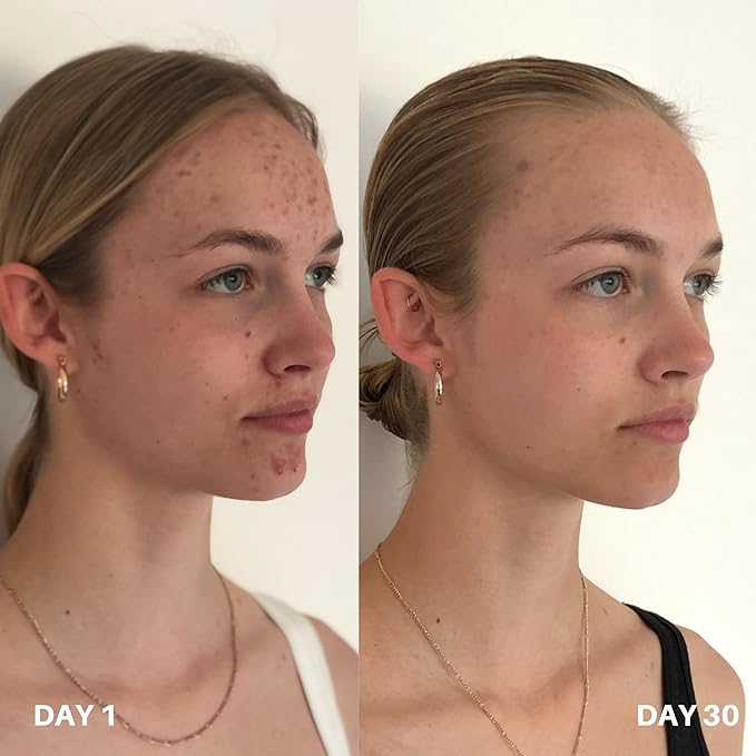 Clinisoothe+ Skin Purifier – Daily Cleanser and Acne Treatment for Face & Body, with Hypochlorous Technology to Prevent Breakouts & Promote Rapid Recovery, For All Skin Types (3.4oz Spray Bottle)