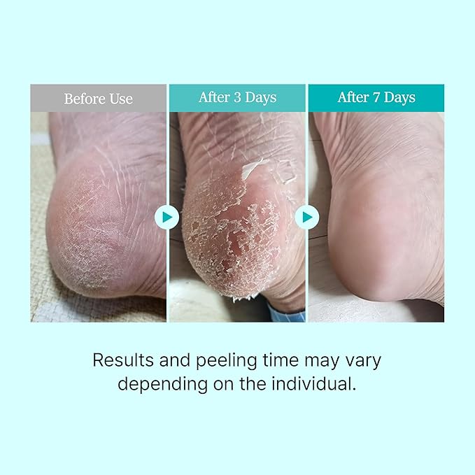 Ariul Smooth & Pure Foot Peel Mask, Intensive Exfoliating Foot Peeling Socks for Thick Dead Skin & Callus Removal, Korean Skincare, 2 Pairs (Kiwi)