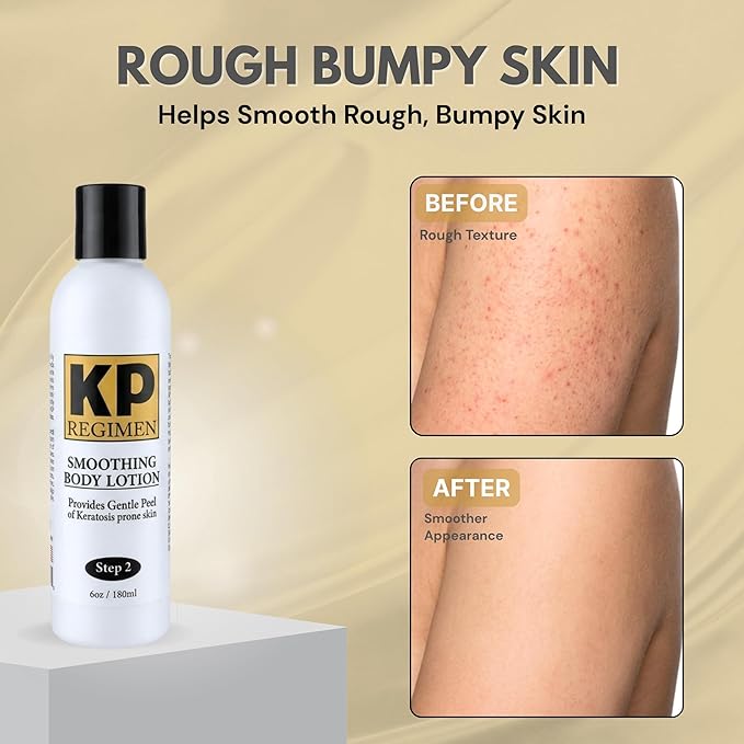 KP Regimen Keratosis Pilaris Exfoliating Body Lotion For Treatment of Keratosis Prone Skin - 6.0 OZ
