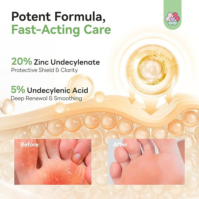 SAVILAND Antifungal Cream 120g Extra Strength: Max 25% Undecylenic Acid Fungal Cream for Skin Athletes Foot Jock Itch Ringworm Foot Fungus Treatment Natural Skin Relief with Tea Tree & Oregano Oil