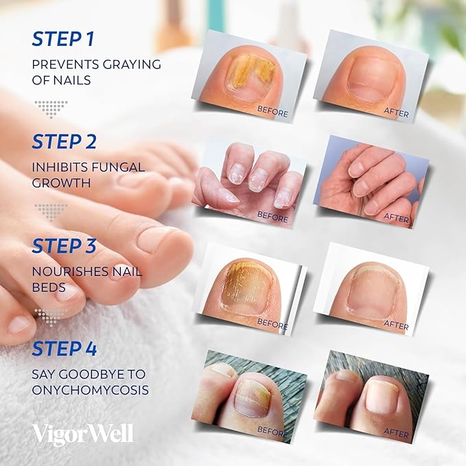 Small Nail Patches Extra Strength: 32 PCS Nighttime Hydrogel Patches for Overnight Repair - Visible Results in 8 Hours - Toenail Extra Strength