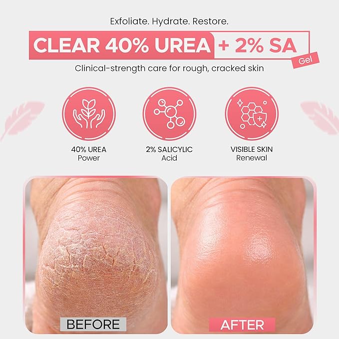 Scientific Solutions Global CLEAR 40 +SA Gel 8oz – 40% Urea + 2% Salicylic Acid Foot & Hand Cream for Dry, Rough Skin – Softens Calluses & Cracked Heels, Aloe Vera & Tea Tree Oil