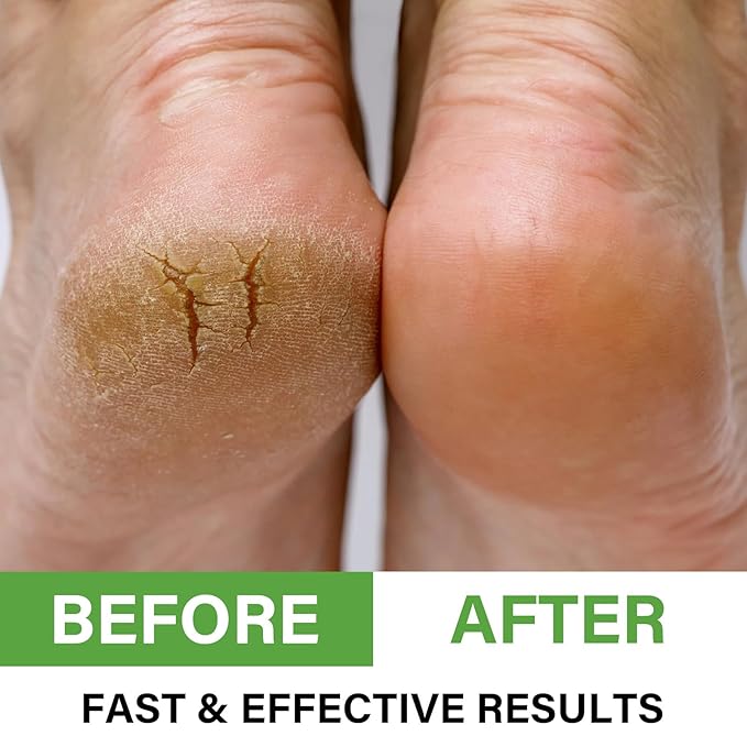 Urea Cream 60 Percent for Feet Maximum Strength, Foot Cream for Dry Cracked Heels and Feet, Foot Moisturizer, 5.29oz/150g