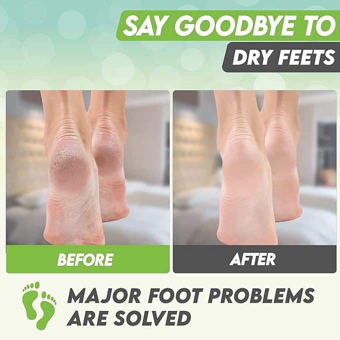 Foot Peel Mask Green Tea Moisturizing Exfoliating Foot Masks - Karma Organic Feet Peeling Masks for Dry ed Feet, Remove Dead Skin & Calluses - Removes & Repairs Rough Heels, Dry Toe Skin (Pack of 2)