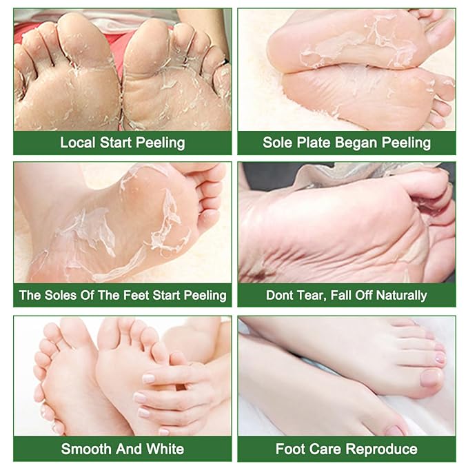 Foot Peel Mask 5 Pack, Skin Exfoliating Foot Masks, Natural Exfoliator for Dry, Callus, Dead Skin Remover, Repair Rough Heels Feet Peeling Mask for Men Women (Tea Tree Scent)