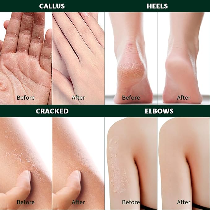 Urea 60% Cream with 2% Salicylic Acid – Maximum Strength Foot, Hand and Elbow Cream for Dry, Cracked Skin, Toenail Softening with Aloe Vera,Tea Tree & Jojoba Oil 2.65 oz.
