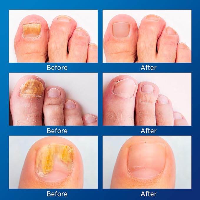 Small Nail Patches Extra Strength: 32 PCS Nighttime Hydrogel Patches for Overnight Repair - Visible Results in 8 Hours - Toenail Extra Strength