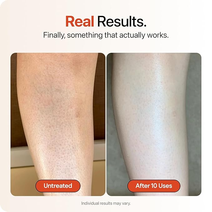 STRAWBERRY® Resurfacing Cream for Keratosis Pilaris - KP Bump Eraser Skin - Exfoliating Lotion with Glycolic, Lactic & Salicylic Acid - Remover for Rough & Bumpy Skin 12 oz (3 pack)