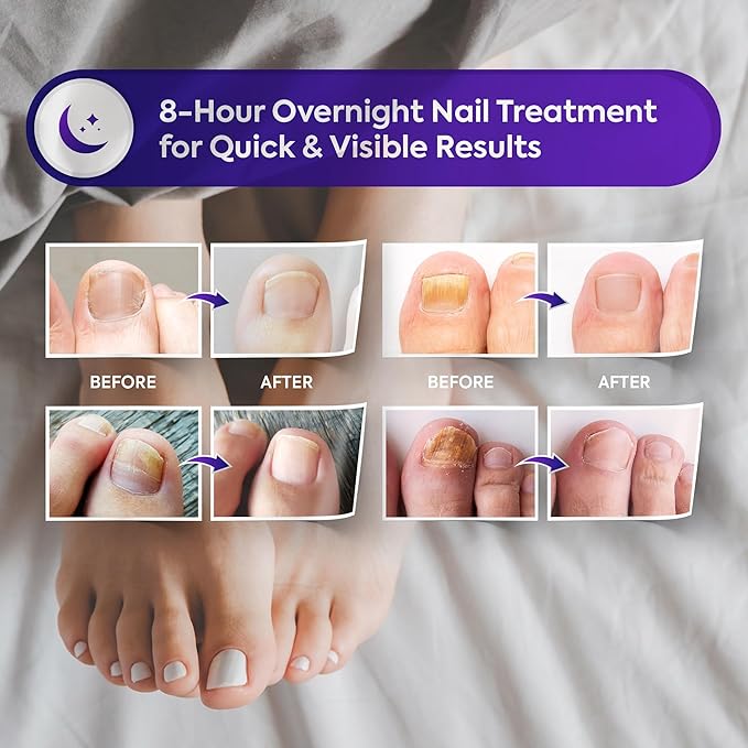 Natural Vine Fungal Nail Patches: Hydrogel Moisture Formula for Toenail and Fingernails - 8-Hour Nighttime Renewal with 1% Tolnaftate - Toenail Fungus Treatment Extra Strength 32 Patches