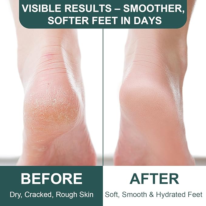 Urea Cream 60 Percent for Feet Maximum Strength with 2% Salicylic Acid 8.45 oz, Foot Cream for Dry Cracked Heels and Feet with Jojoba Oil, Avocado Oil & Aloe Vera, Urea Lotion for Callus Remover
