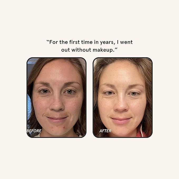 Barefaced Brightening Serum Dark Spot Corrector | Kojic Acid, Arbutin, Azelaic Acid & Licorice | Anti-Aging, Hydrating | Antioxidant-Powered Formula Fades Hyperpigmentation & Evens Skin Tone (1 Oz)