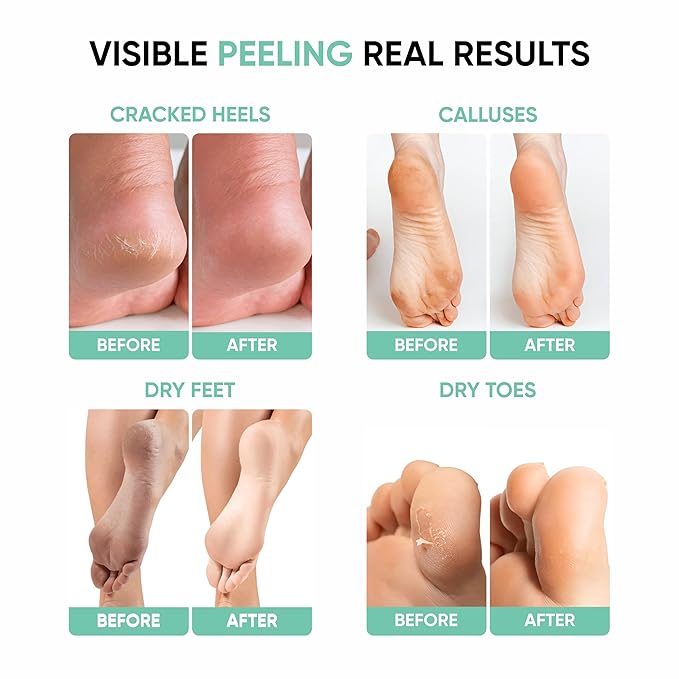 Masofta Exfoliating Foot Peeling Mask for Dry, Cracked Heels & Calluses Glycolic, Lactic & Salicylic Acid Formula Peels Dead Skin in Days Baby Soft Feet Treatment for Men & Women 40 g (Pack of 1)