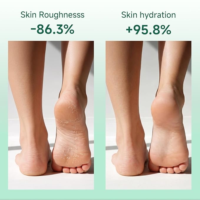 40% Urea Cream for Feet Maximum Strength, Foot Cream for Dry Cracked Heels, Callus Remover with 2% Salicylic Acid, Moisturizer for Hands Elbows Knees Rough Skin, 3 Packs