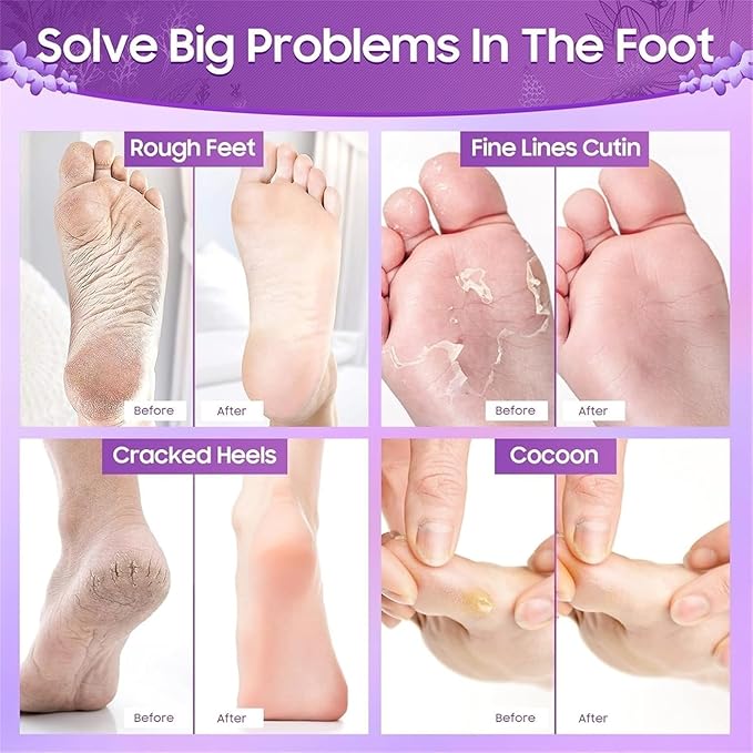 Foot Peel Mask for Women & Men | Peeling & Exfoliating Foot Mask for Dry Cracked Feet, Removes Dead Skin & Calluses, Hydrates & Smooths Cracked Heels (Standerd, Lavender)