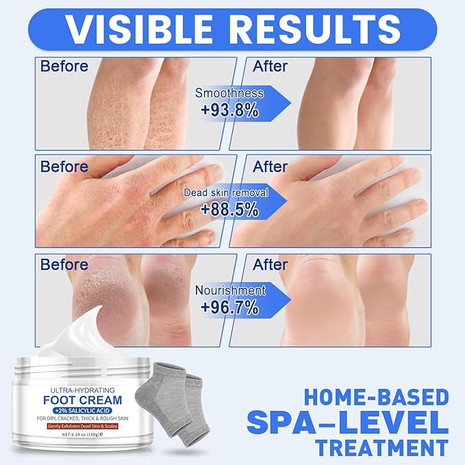 TEAWOO Ultra-Hydrating Urea Cream (Urea Conc. 40.67%), Foot Cream for Dry Cracked Heels and Feet, Pair with Moisturizing Heel Socks for Cracked Heel Treatment, Heel Socks Included (5.29 OZ/150g)