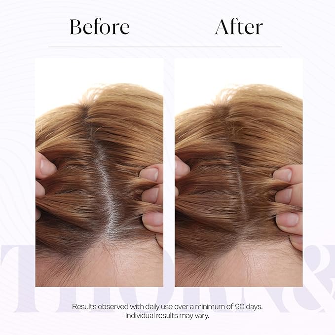 Hair Growth Serum for Thinning Hair | Thicker Fuller Hair Thickening Serum | Rosemary Oil, Saw Palmetto, Biotin | Multi Peptides, Redensyl, Topical Caffeine Scalp Serum for Women | Density DHT Blocker