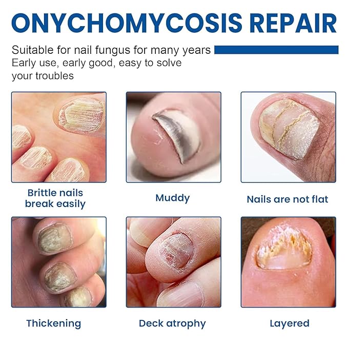Toenail Fungus Treatment Extra Strength, 60Pcs Fungal Nail Patches for Damaged Nails, 8-Hour Nighttime Renewal & Natural Hydrogel Nail Repair Patches