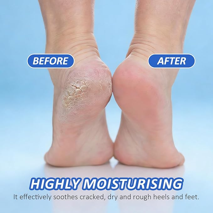 Urea Cream 60% with Salicylic Acid 2% Foot Care Stick, Deeply Moisturizing and Hydrating Foot and Hand Balm, Gentle Exfoliation Anti-Cracking Foot Cream