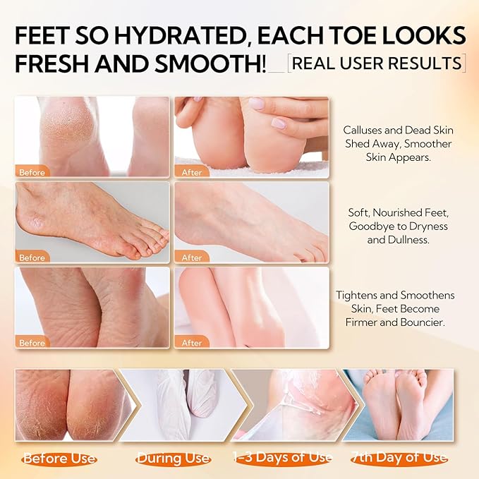 LANBENA Vitamin C Foot Peeling Mask, Foot Mask for Dry Cracked Feet, Exfoliator Peel Off Calluses Dead Skin Callus Remover, Repair Rough Heels & Get a Baby Soft Feet for Men and Women(2 Pairs)