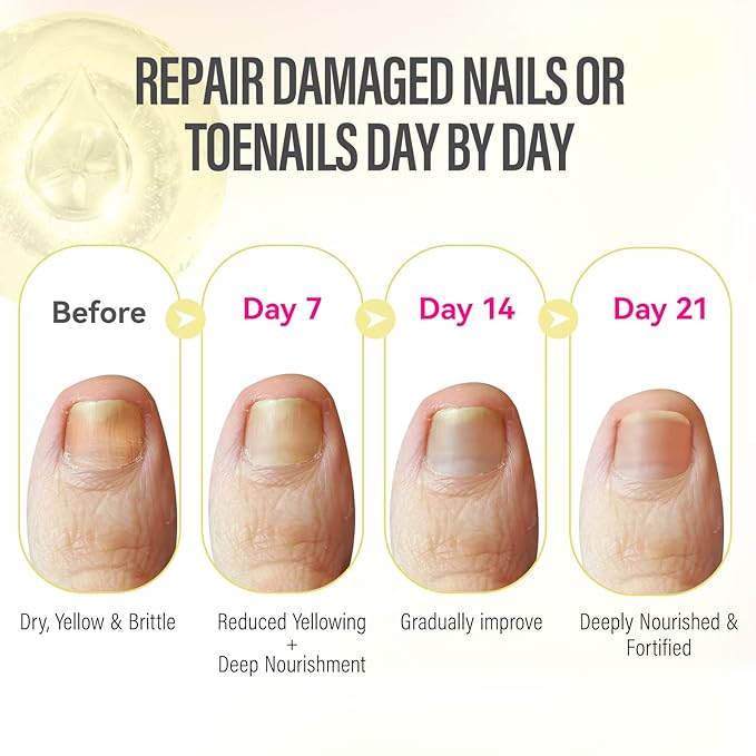 CHUCHU Vegan Cuticle Oil for Nails: Tea Tree Jojoba Nail Cuticle Oil with Vitamin B & E for Moisturizes Cuticle and Nail's Skin - Prevents Hangnails and Chapped 15ML