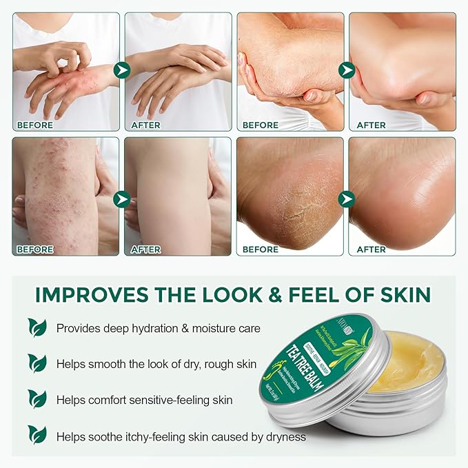 Tea Tree Oil for Skin, Tea Tree Balm 2 oz, Soothing Moisturizing Balm for Dry & Sensitive Skin, Helps Calm Itchy, Irritated Areas, Suitable for Feet, Body & Daily Use, Natural