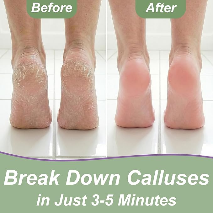 Callus Remover Gel & Double-Sided Foot File: 8 oz Extra Strength Callus Remover for Feet, Foot Callus Remover Care, Pedicure Tools Supplies, Spa Kit, Dead Skin Scrubber