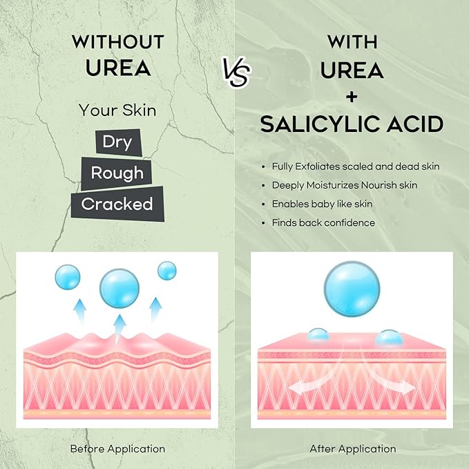 Urea Cream 42% Foot Cream Salicylic Acid 4 Oz, Upgraded Callus Remover For Feet, Knees& Elbows, Intensive Moisturizes & Softens Skin, Exfoliates Dead Skin