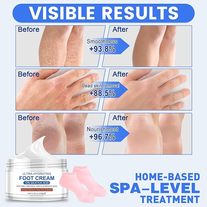 TEAWOO Ultra-Hydrating Foot Cream for Dry Cracked Heels and Feet, Pair with Silicone Socks for Cracked Heel Treatment, Silicone Socks Included (Urea Conc. 40.67%, 5.29 OZ/150g)