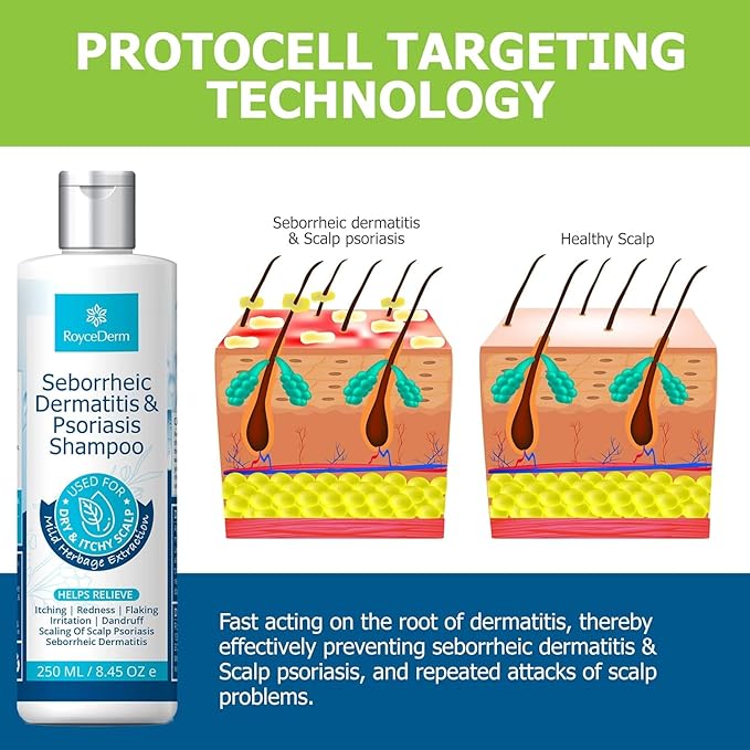 Roycederm Seborrheic Dermatitis & Psoriasis Shampoo for Dandruff - Helps Relieve Itching, Flaking & Scaling, Dry Itchy Scalp
