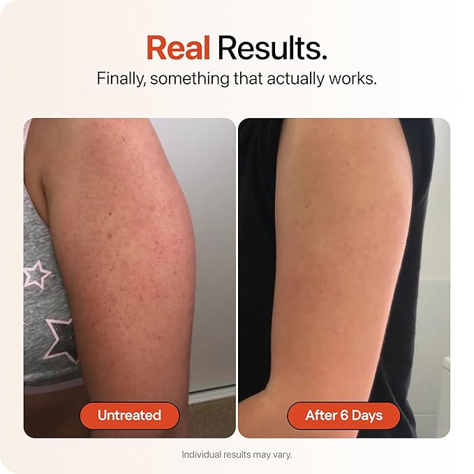 STRAWBERRY® Resurfacing Cream for Keratosis Pilaris - KP Bump Eraser Skin - Exfoliating Lotion with Glycolic, Lactic & Salicylic Acid - Remover for Rough & Bumpy Skin 12 oz (3 pack)