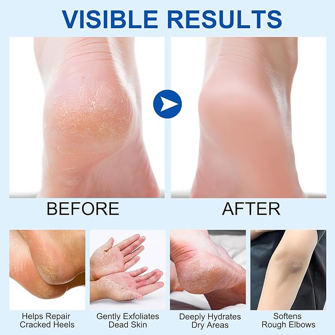 NovaCharm Urea Cream Stick 60%, 2PCS Aloe Vera & Honey Cracked Heel Repair Stick Balm, Maximum Strength Urea Cream for Feet, Foot Lotion for Dry Hands & Rough Knees, Callus Remover - Smoothing Skin