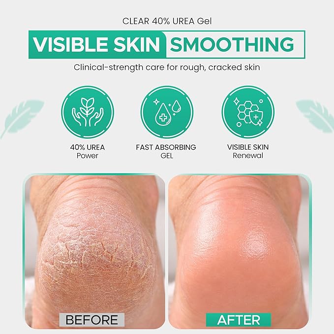 CLEAR 40 Urea Gel 40% (4 oz) with Tea Tree & Coconut Oil & Aloe Vera – Intensive Moisturizing & Exfoliating Gel for Dry Rough Skin, Feet, Heels, Elbows, Hands & Nails – Fast Absorbing Hydration