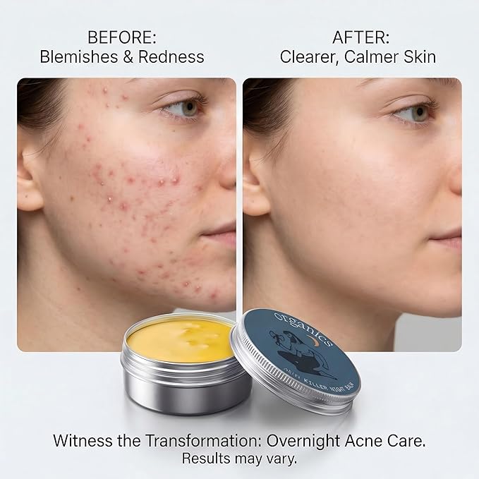Acne & Redness Relief Balm, Natural Face Cream for Blemish & Oil Control, Plant-Based Moisturizing Skin Care for Sensitive, Oily & Combination Skin, 1PCS