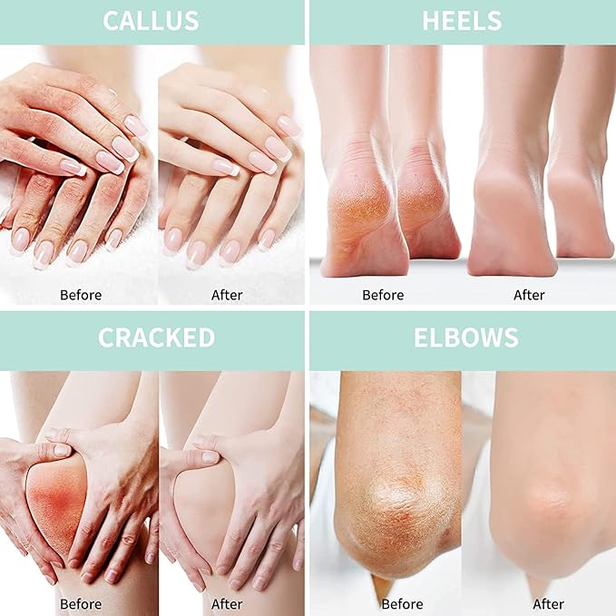 Grocerism Urea Cream 20 Percent For Feet Plus 2% Salicylic Acid 8.82 oz || Foot Cream and Hand Cream Maximum Strength with Hyaluronic Acid, Tea Tree, and Aloe Vera for Deep Moisturizes, Callus Remover