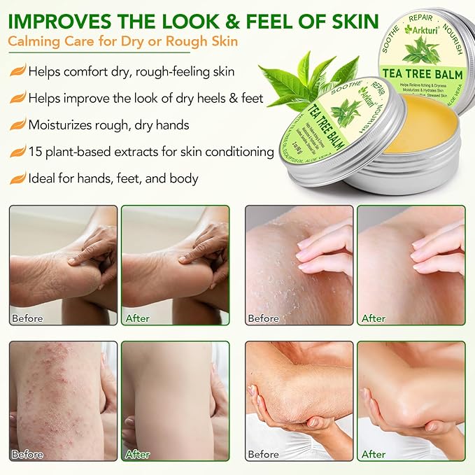 Tea Tree Oil Balm, Tea Tree Oil for Skin, Tea Tree Oil Balm for Dry Skin Relief - Irritated Skin, Cracked Heels - Organic & Safe for All Ages (2 Pack)