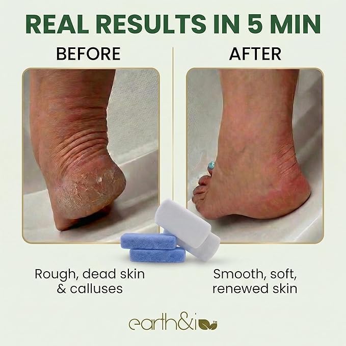 Earth & I Pumice Stone for Feet – 6-Pack Callus Remover Set | 3 Coarse + 3 Fine Dual-Grit Dead Skin Scrubber & Heel Exfoliator for Baby-Soft Feet