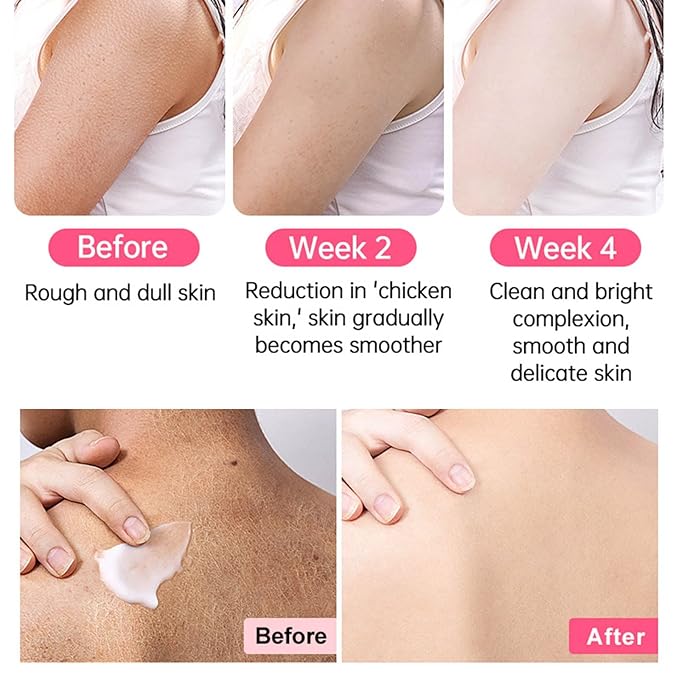 Strawberry Legs Treatment For Women,Bump Eraser Body Scrub, Keratosis Pilaris Treatment,Rough Bumpy Body Cream, Bump Eraser Body Scrub,Smoothing & Buffing Body Scrub Body Care