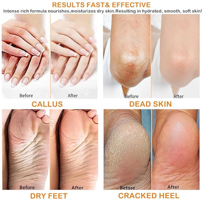 40% Urea Cream Cracked Heel Balm for Dry, Cracked Feet, Heals, Foot Hand Moisturizing 40 Percent Foot Urea Cream for Feet Maximum Strength 2Pack
