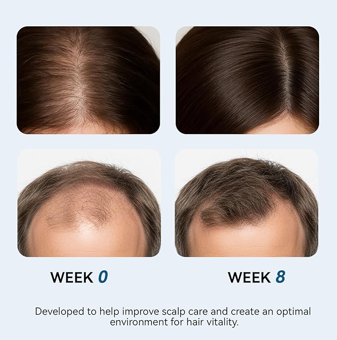 Rosemary Hair Growth Serum Roll On – 3% Rosemary, 2% Ginger Root Oil & 3% Aloe Vera Extract | Strengthens Hair, Reduces Hair Fall | Paraben & Sulfate-Free | Women & Men | 25 ml