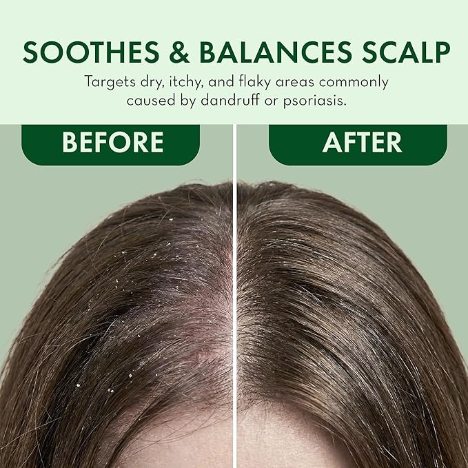 Leave In Conditioner Spray – Rosemary & Mint Scalp Treatment (2 Pack) – Anti-Dandruff, Dry & Itchy Scalp Relief, Hydrating Formula for Psoriasis Care – Detangles & Nourishes Hair