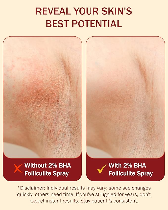 e70 Folliculitis Treatment 2% BHA Body Spray - Salicylic Acid with Tea Tree Oil & Aloe Vera - Spray Moisturizer for Dry Skin, Clogged Pores & Irritation by Made in USA, 4 fl. oz