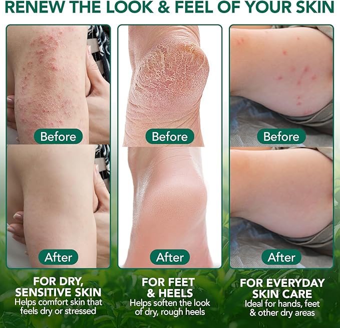 Tea Tree Balm for Fast Itchy Skin Relief – Soothes Discomfort from Bug Bites, Rashes, Dry Skin & Foot Irritation – Natural, Fragrance-Free & Gentle Formula, Safe for Sensitive Skin and All Ages
