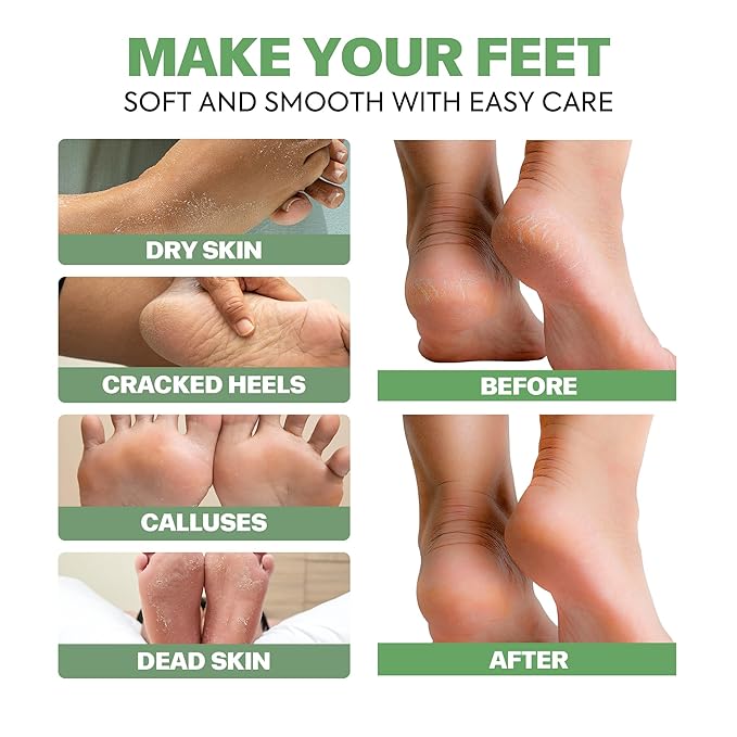 Tea Tree & Aloe Foot Care Set - Urea Cream,Callus Remover Gel & Foot Callus Remover,10Pairs Mask Sleeves for Dry Cracked Feet - Pedicure Kit for for Birthday Women Men Gift