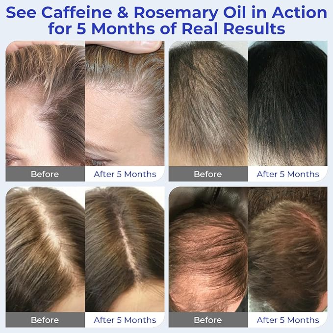 Rosemary Oil Hair Growth Serum Roll On – 3% Rosemary Oil, 2% Caffeine, 2% Niacinamide & DHT Blocking Complex, Non-Greasy Scalp Serum for Men & Women, Designed for Thinning, Fine & Weak Hair