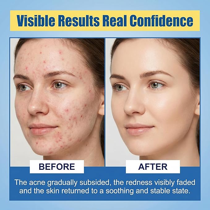 Redness Relief Face Balm, Plant-Based Moisturizing Balm for Blemish-Prone Skin, Soothing Care for Sensitive, Oily & Combination Skin, Supports Skin Barrier, Daily Facial Care, 1.05 Oz