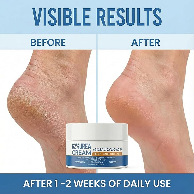 Grospe Urea Cream 62% with 2% Salicylic Acid Foot Cream for Dry Cracked Heels Feet Intensive Callus Remover Exfoliating Hand Cream for Rough Knees Elbows Dead Skin Remover Moisturizer Lotion, 2 Pack