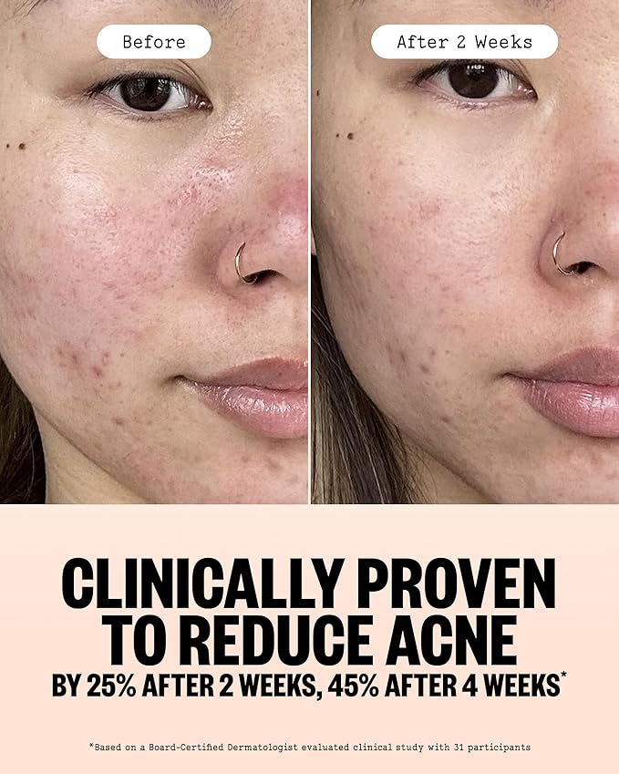 PEACE OUT Acne Gel Cleanser, With 2% Salicylic Acid for Breakouts, Blemishes & Blackheads, Daily Face Wash with Ceramides to Unclog Pores, Support Skin Barrier (4 fl oz)