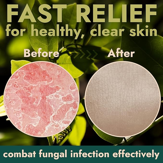 KP Bump Eraser Body Set & Antifungal Soap | Keratosis Pilaris Treatment, Exfoliating Body Scrub, Lotion & Ingrown Hair Care | Medicated Jock Itch, Ringworm & Athlete’s Foot Relief