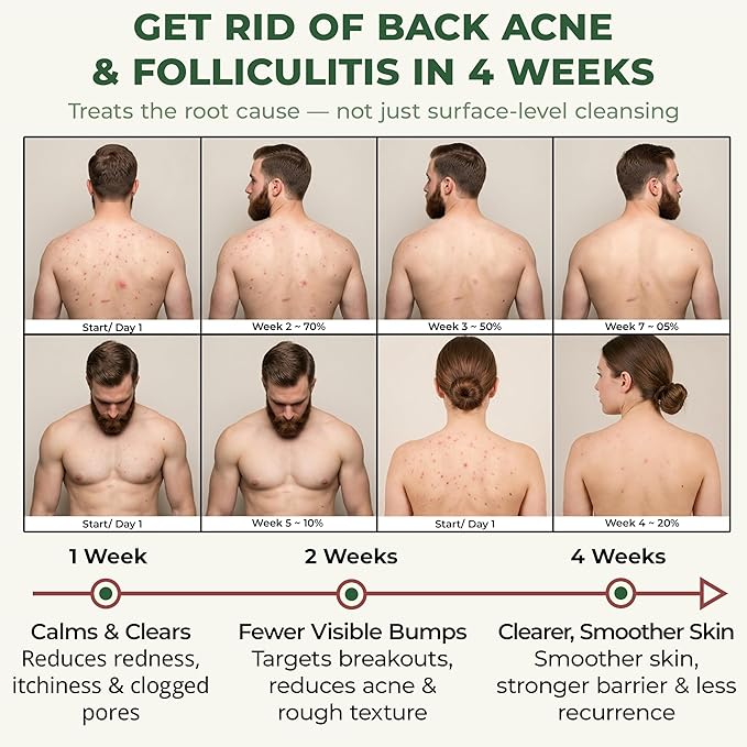 ABERA Folliculitis Shower Gel, High-Performance BHA Body Wash with Wild Bitter Melon Extract, 1 BOX + GIFT Back Acne Spray with Neem & Scutellaria Extract, Azelaic Acid, Clears Acne & Fades Dark Spots