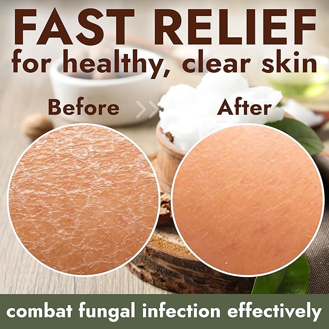 Antifungal Soap Infused with Shea Butter & Rose Oil | Medicated Jock Itch Treatment Helps Fight Ringworm & Athlete’s Foot | Tolnaftate 1% Antifungal Soap for Deep Cleansing | 2 Bars with Scrubber